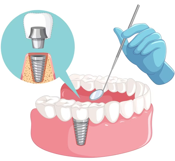 Dental Implant treatment in Gurgaon