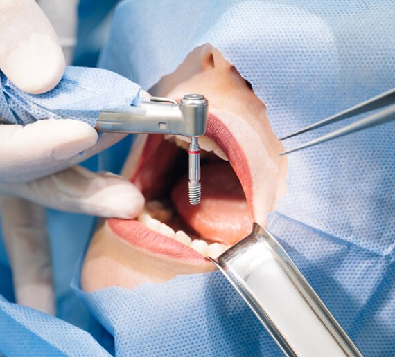 expert root canal treatment in gurgaon