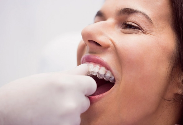 Dentru offers clear aligner treatment in New Gurgaon for discreet smile care. Transparent Teeth Alignment
