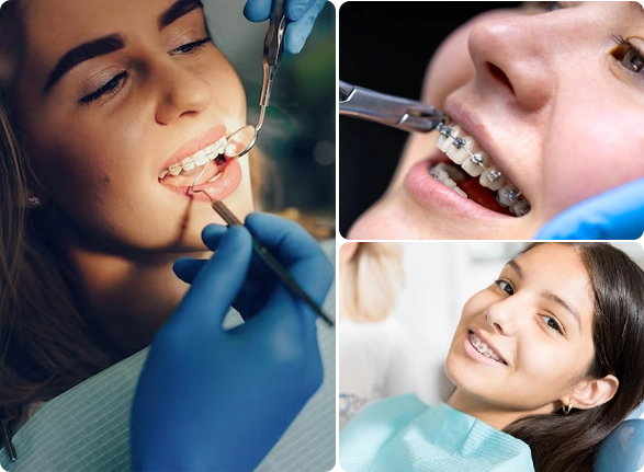 Orthodontic services in New Gurgaon at Dentru for teeth alignment and smile correction Orthodontic Smile Care
