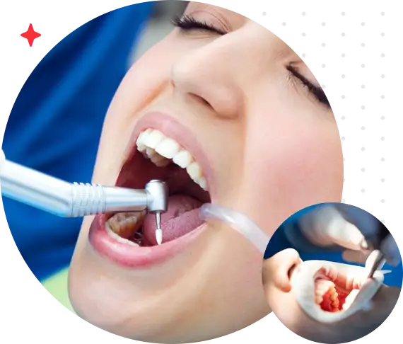 Root Canal Therapy On-Time - DenTru New Gurgaon