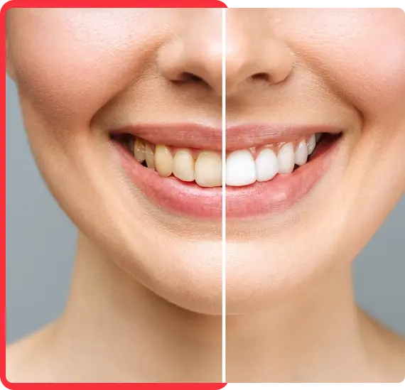 Benefits of Teeth Whitening Treatment - DenTru New Gurgaon