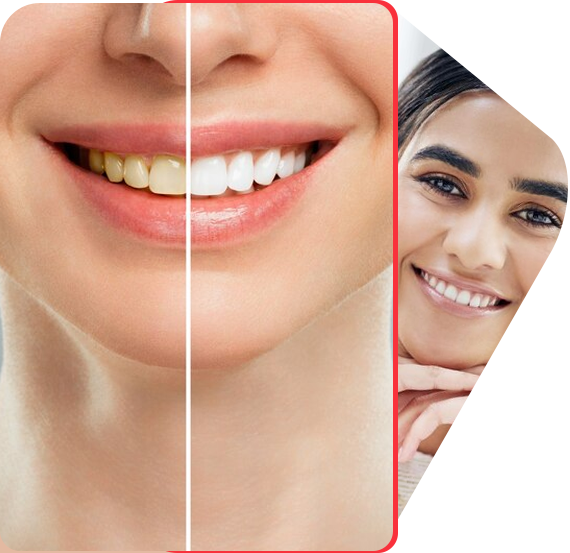 Teeth Whitening Treatment in Gurgaon