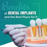 Benefits of Dental Implants and the Best Place for it
