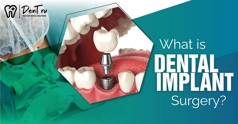 What is Dental Implant Surgery?